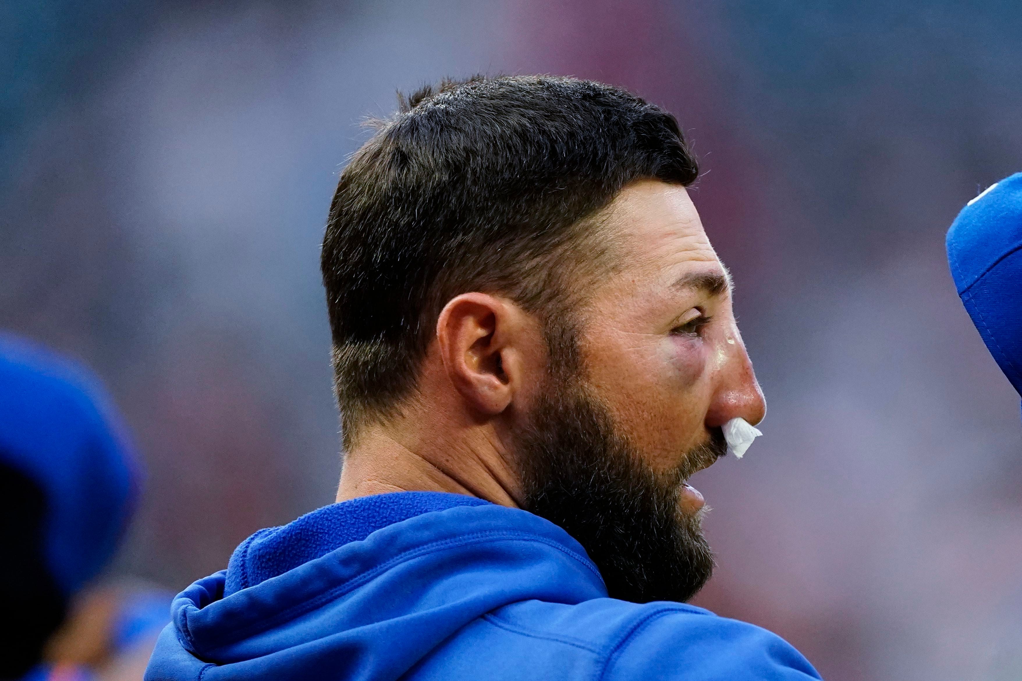 Mets' Pillar has multiple nasal fractures after hit by pitch – The
